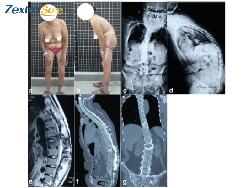 Ankylosing-spondylitis-in-women (2)